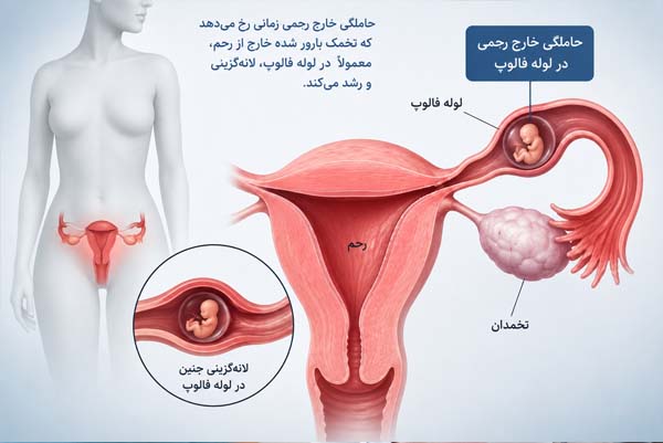 حاملگی خارج رحمی